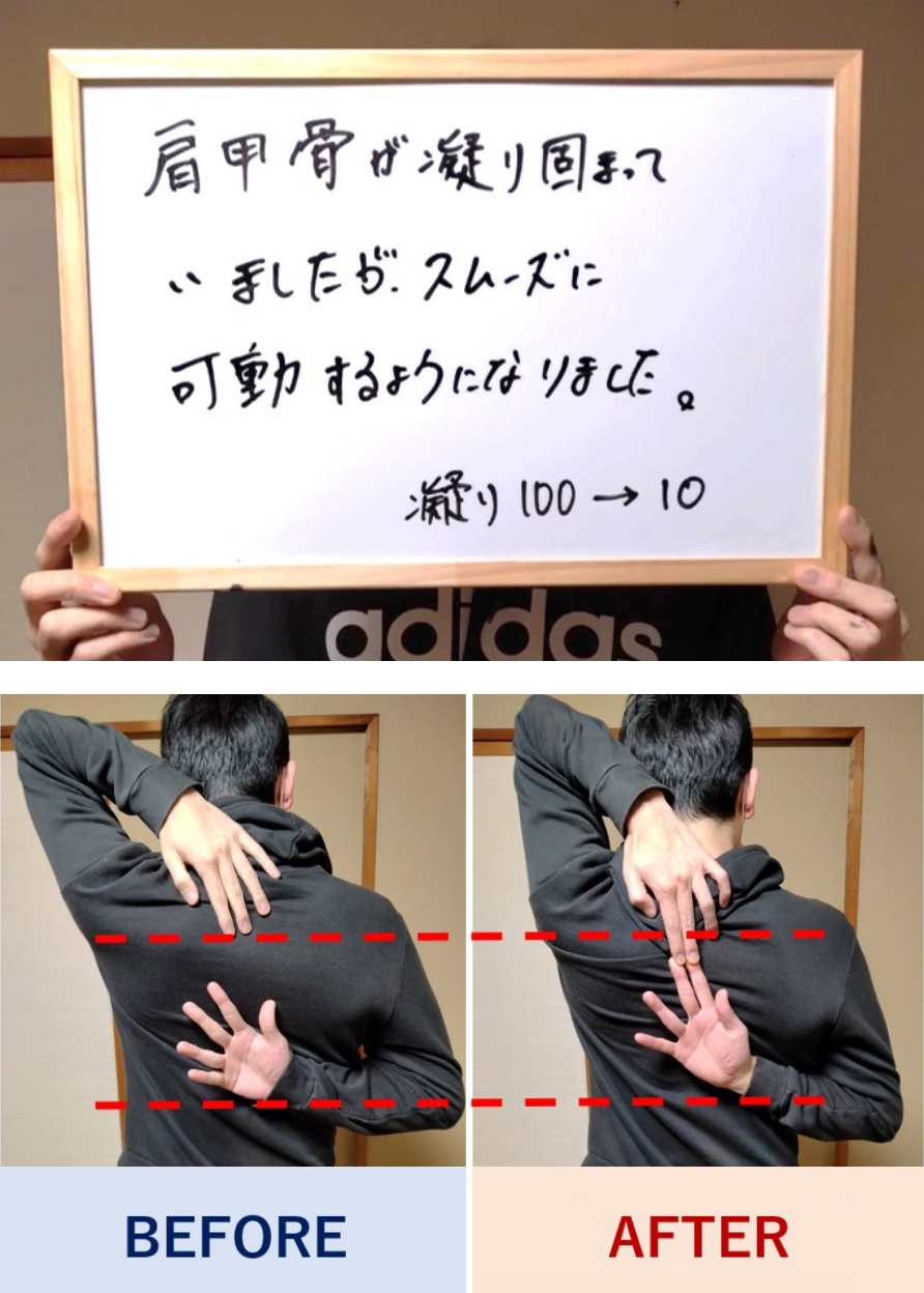 肩甲骨が凝り固まっていましたが、スムーズに可動するようになりました。凝りが100から10になりました。